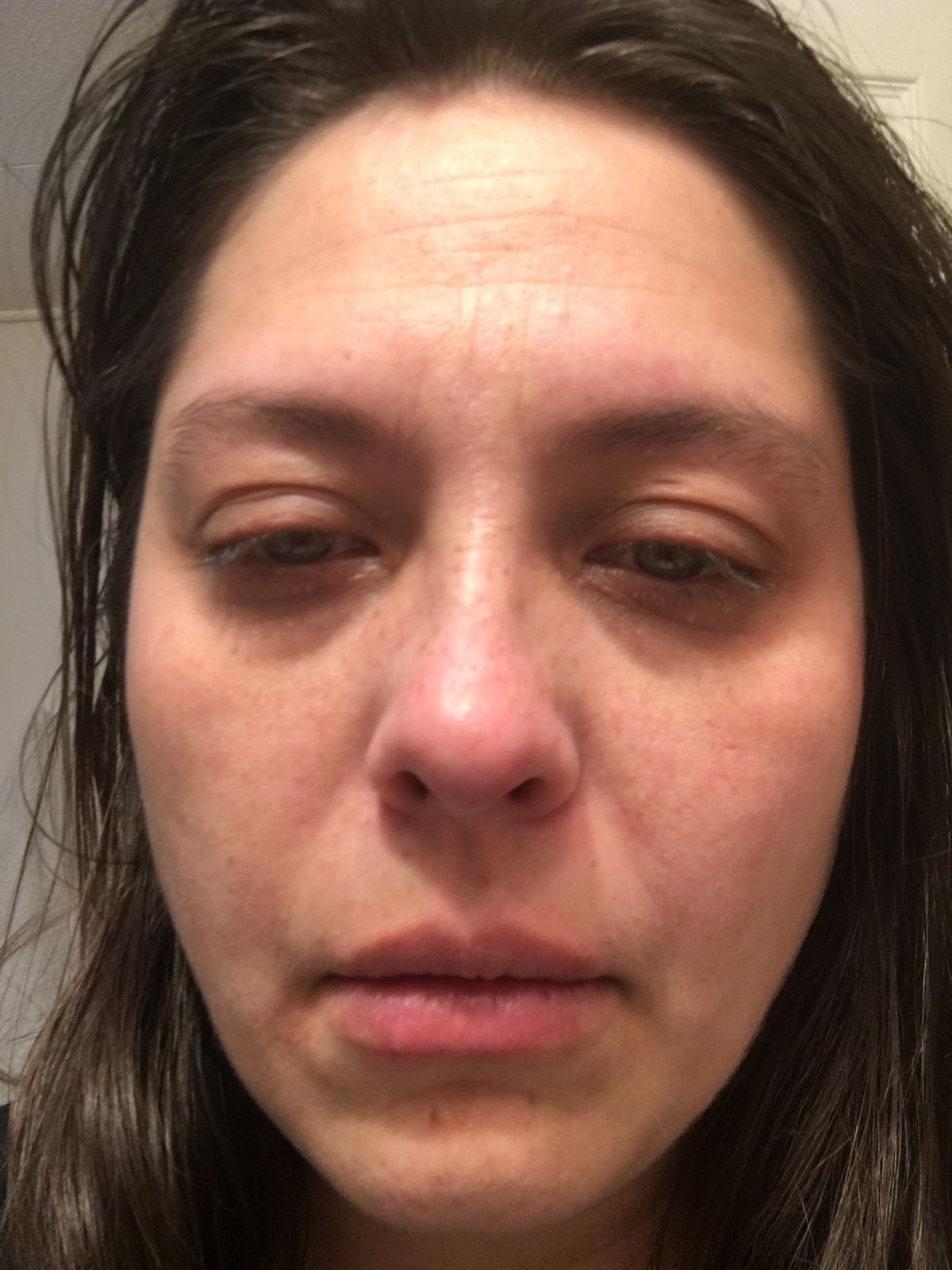 Despertar y no reconocer tu propio rostro hinchado